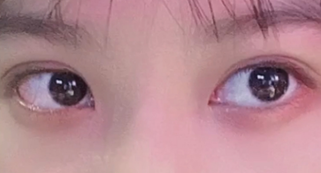 雙眼皮定點(diǎn)能維持多久？