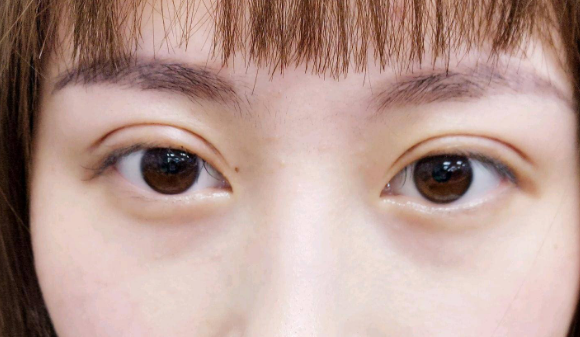 定點(diǎn)雙眼皮是什么意思？