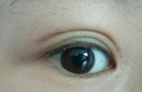 定點(diǎn)雙眼皮是怎么做的？