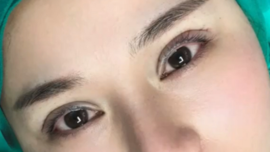 40歲做埋線雙眼皮的效果好不好？