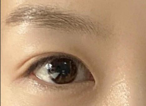 割雙眼皮后自然嗎？