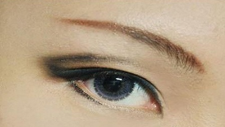 疤痕皮膚可以割雙眼皮嗎？