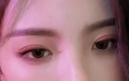 割雙眼皮會有疤痕嗎？割雙眼皮幾個月定型？