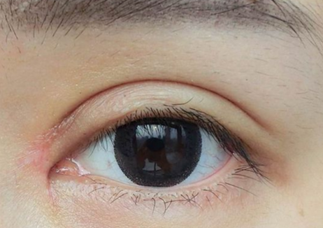 半切雙眼皮是永久的嗎？半切和全切雙眼皮的區(qū)別？