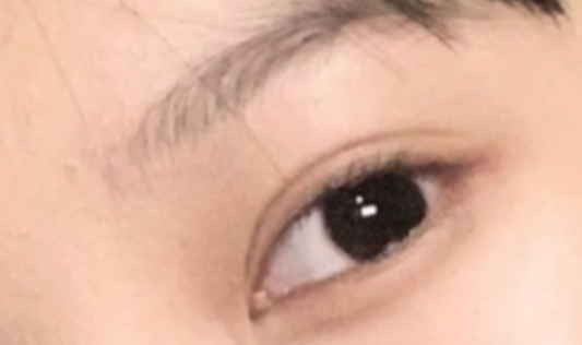 割雙眼皮恢復(fù)需要多久？割雙眼皮會(huì)不會(huì)很痛？