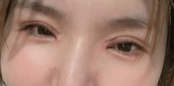割雙眼皮后要冰敷多久？
