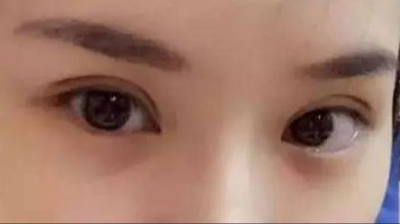 做雙眼皮對身體有沒有危害？