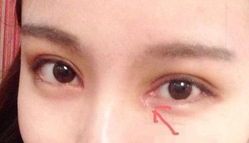 單眼皮開內(nèi)眼角會(huì)留疤嗎？