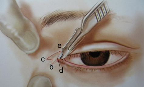 疤痕體質可以割雙眼皮開眼角嗎？能一起做嗎