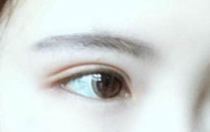 開眼角的恢復(fù)期多長(zhǎng)？開眼角的后遺癥都有什么？