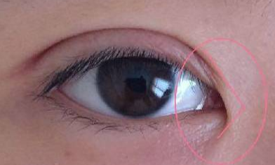 韓式開(kāi)眼角恢復(fù)要多久？韓式開(kāi)眼角術(shù)后有什么注意事項(xiàng)？