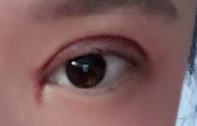 韓式開眼角手術有哪些優(yōu)勢？