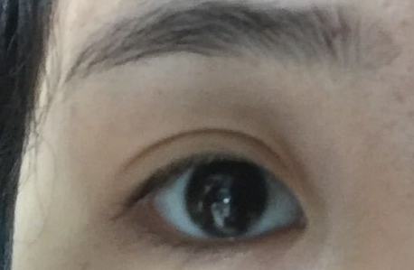 開內(nèi)眼角拆線后變化明顯嗎？