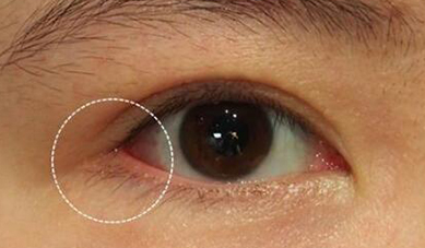 開內眼角可能會出現什么后遺癥？