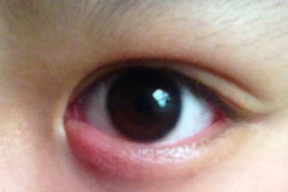 開內(nèi)外眼角的缺點(diǎn)有哪些？