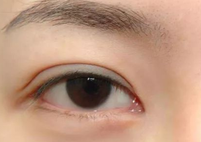 開(kāi)內(nèi)外眼角多久能恢復(fù)好？開(kāi)內(nèi)外眼角多少錢(qián)？