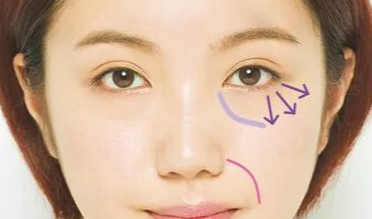 開內(nèi)外眼角的效果如何？開內(nèi)外眼角的缺點？