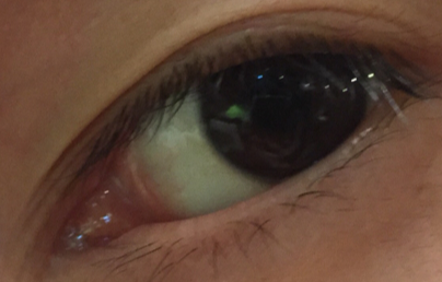 開眼角大概多少錢？開外眼角效果好不好？