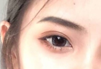 開內(nèi)外眼角的恢復(fù)期是多久？術(shù)后后遺癥有哪些？