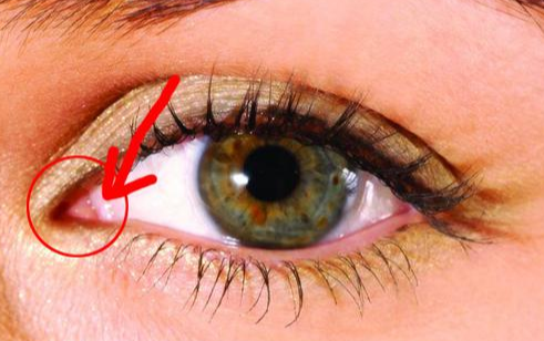 開內眼角手術有什么效果？