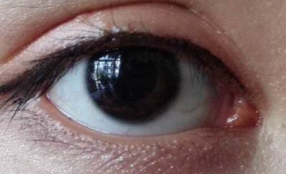 開眼角幾天能恢復(fù)？