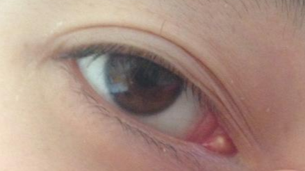 開(kāi)內(nèi)外眼角的方法有哪些？