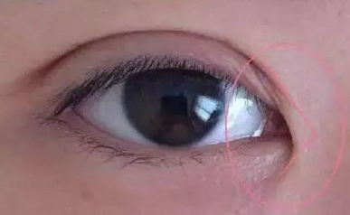 開內(nèi)眼角的作用有哪些？