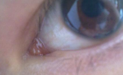 開內(nèi)外眼角需要注意什么？