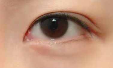 開(kāi)內(nèi)眼角的優(yōu)缺點(diǎn)有哪些？