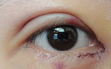 開內(nèi)眼角的過程中會疼嗎？