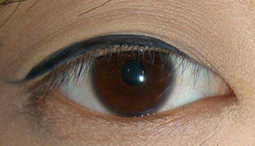 開內(nèi)眼角的風(fēng)險有哪些？