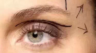 開內(nèi)外眼角需要幾次？