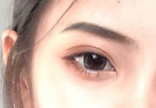 開內(nèi)外眼角怎么消腫快？開內(nèi)外眼角有什么壞處？