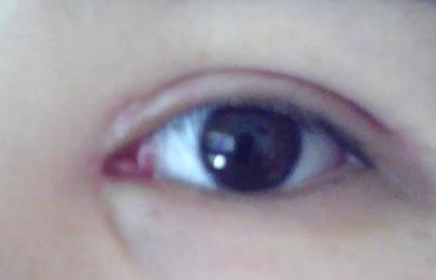 開(kāi)內(nèi)外眼角效果怎么樣？開(kāi)內(nèi)外眼角需要多長(zhǎng)時(shí)間？