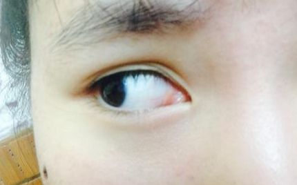 開內(nèi)眼角風險有多大？