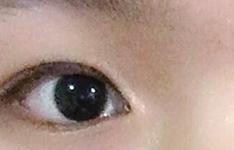 開(kāi)內(nèi)眼角的危害有哪些？