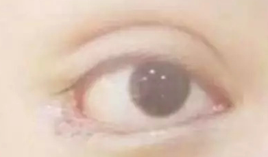 開內(nèi)眼角的效果好嗎？