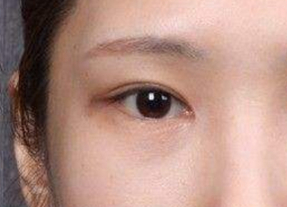 開內(nèi)外眼角腫幾天？