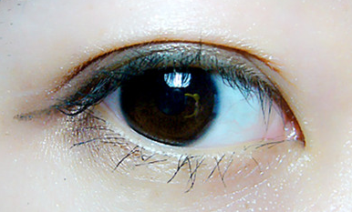 開內(nèi)眼角怎么避免并發(fā)癥？