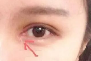 開眼角割雙眼皮拆線嗎？術后拆線疼嗎？