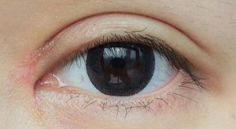 開眼角有哪些優(yōu)缺點(diǎn)？開眼角方法的過(guò)程有哪些？