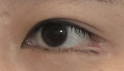 開眼角是永久的嗎？