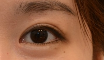 開眼角有效果嗎？開眼角有哪些危害？