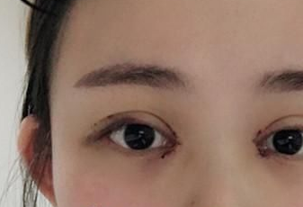 開眼角后多長時間能恢復(fù)？