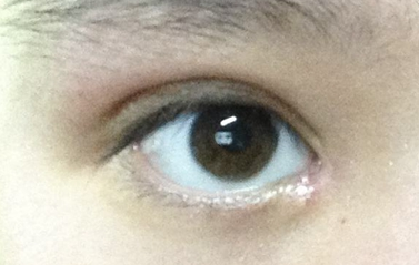 開眼角一定會(huì)出現(xiàn)疤痕嗎？