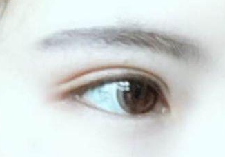 開眼角有幾種方法?開眼角有后遺癥嗎？