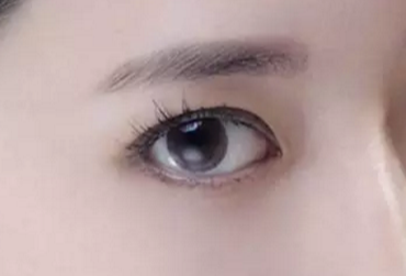 開(kāi)眼角術(shù)后會(huì)不會(huì)反彈？