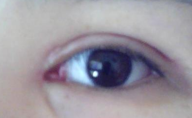 開眼角手術(shù)有沒有風(fēng)險(xiǎn)？開眼角手術(shù)有副作用嗎？