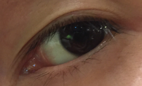 開(kāi)眼角需要熱敷幾天？