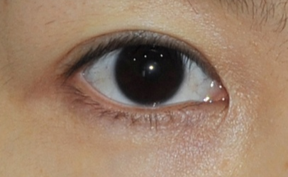 外眼角開大手術(shù)永久嗎？開外眼角手術(shù)會有后遺癥嗎？